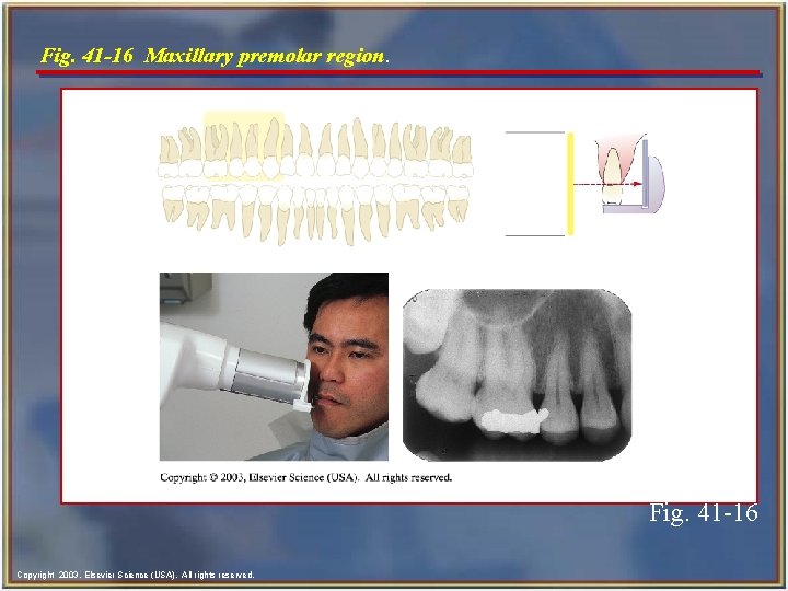 Fig. 41 -16 Maxillary premolar region. Fig. 41 -16 Copyright 2003, Elsevier Science (USA).