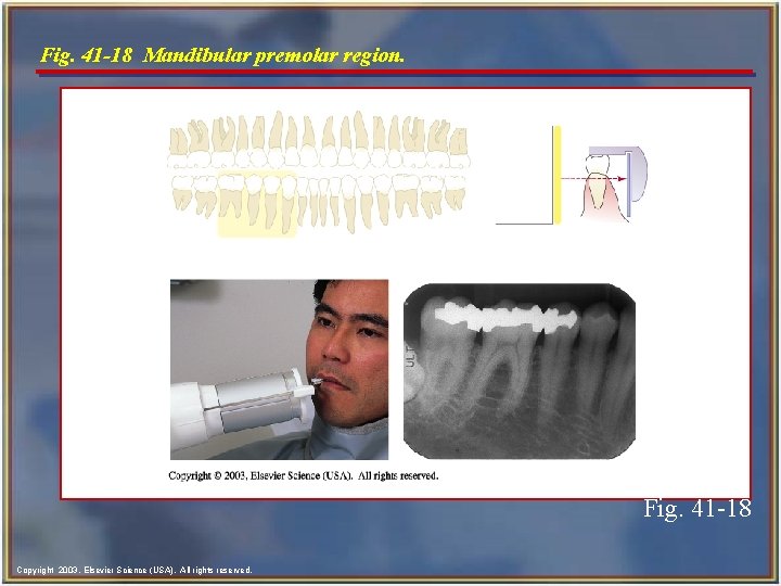 Fig. 41 -18 Mandibular premolar region. Fig. 41 -18 Copyright 2003, Elsevier Science (USA).