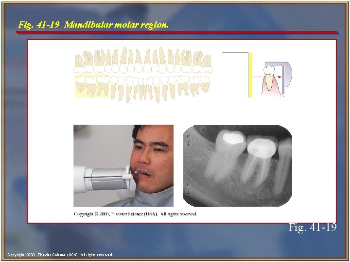 Fig. 41 -19 Mandibular molar region. Fig. 41 -19 Copyright 2003, Elsevier Science (USA).