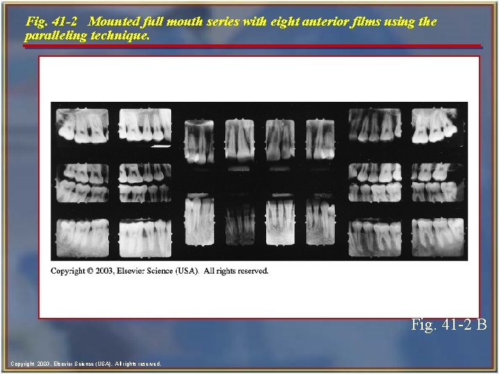 Fig. 41 -2 Mounted full mouth series with eight anterior films using the paralleling