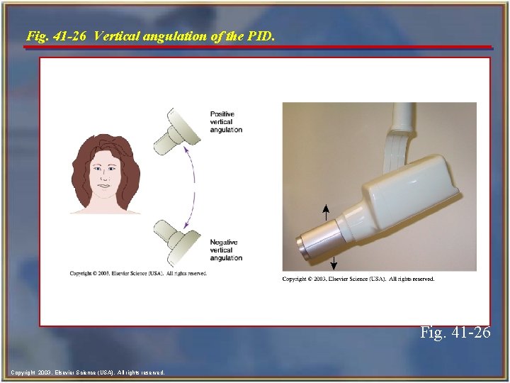 Fig. 41 -26 Vertical angulation of the PID. Fig. 41 -26 Copyright 2003, Elsevier