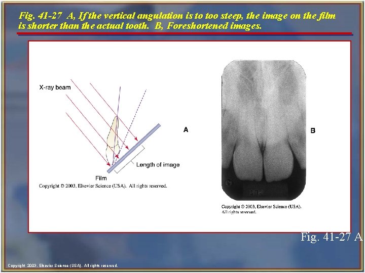 Fig. 41 -27 A, If the vertical angulation is to too steep, the image