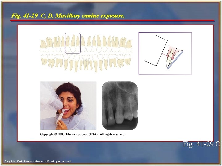 Fig. 41 -29 C, D, Maxillary canine exposure. Fig. 41 -29 C Copyright 2003,