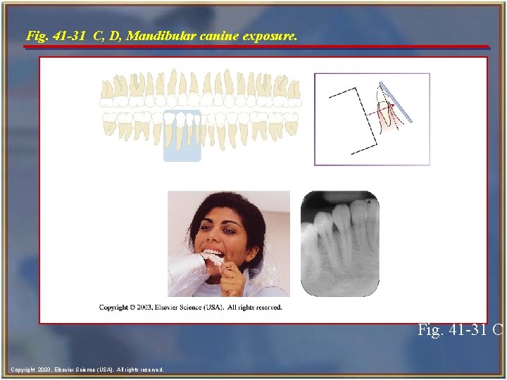 Fig. 41 -31 C, D, Mandibular canine exposure. Fig. 41 -31 C Copyright 2003,