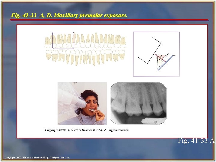 Fig. 41 -33 A, D, Maxillary premolar exposure. Fig. 41 -33 A Copyright 2003,