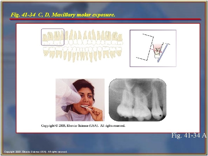 Fig. 41 -34 C, D, Maxillary molar exposure. Fig. 41 -34 A Copyright 2003,