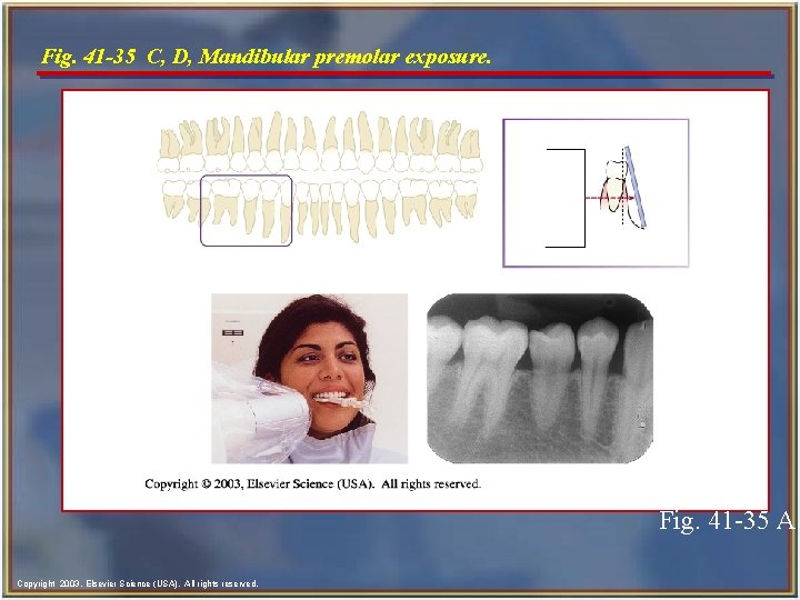 Fig. 41 -35 C, D, Mandibular premolar exposure. Fig. 41 -35 A Copyright 2003,