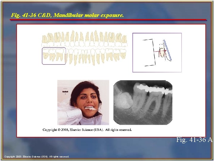 Fig. 41 -36 C&D, Mandibular molar exposure. Fig. 41 -36 A Copyright 2003, Elsevier