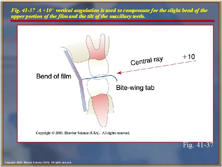 Fig. 41 -37 A +10˚ vertical angulation is used to compensate for the slight