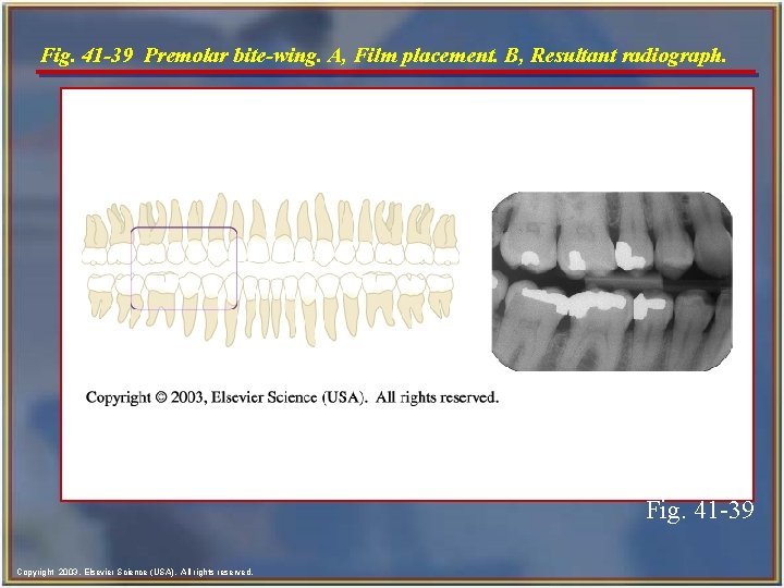 Fig. 41 -39 Premolar bite-wing. A, Film placement. B, Resultant radiograph. Fig. 41 -39