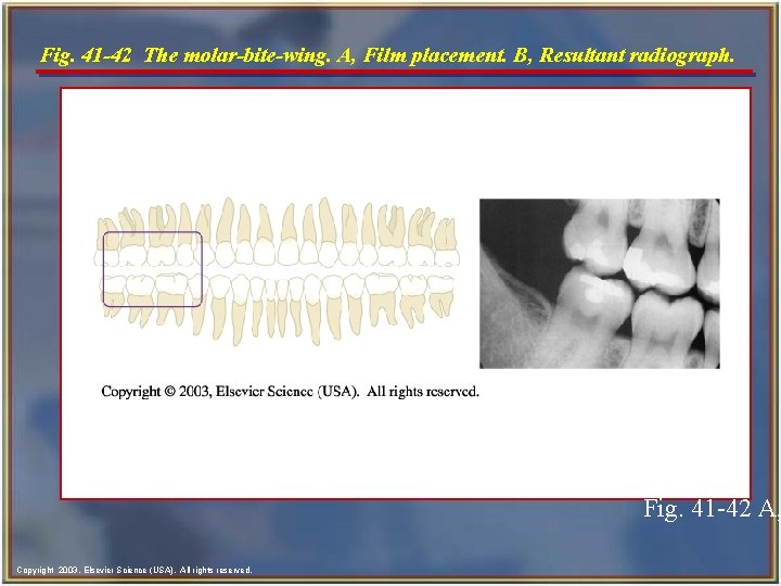 Fig. 41 -42 The molar-bite-wing. A, Film placement. B, Resultant radiograph. Fig. 41 -42