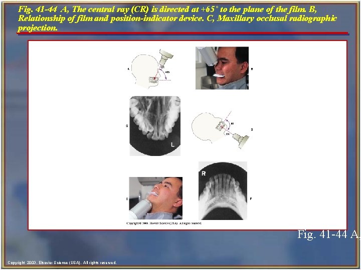 Fig. 41 -44 A, The central ray (CR) is directed at +65˚ to the