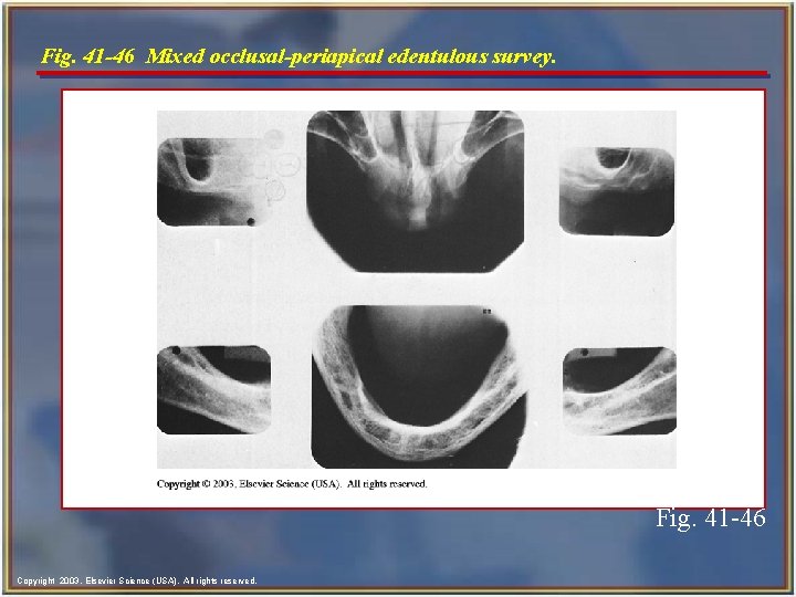 Fig. 41 -46 Mixed occlusal-periapical edentulous survey. Fig. 41 -46 Copyright 2003, Elsevier Science