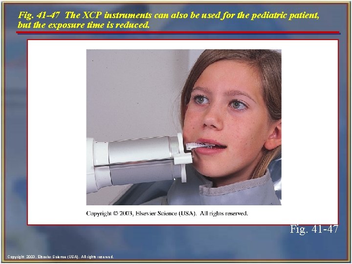 Fig. 41 -47 The XCP instruments can also be used for the pediatric patient,