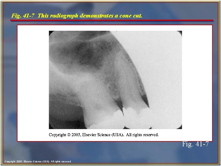 Fig. 41 -7 This radiograph demonstrates a cone cut. Fig. 41 -7 Copyright 2003,