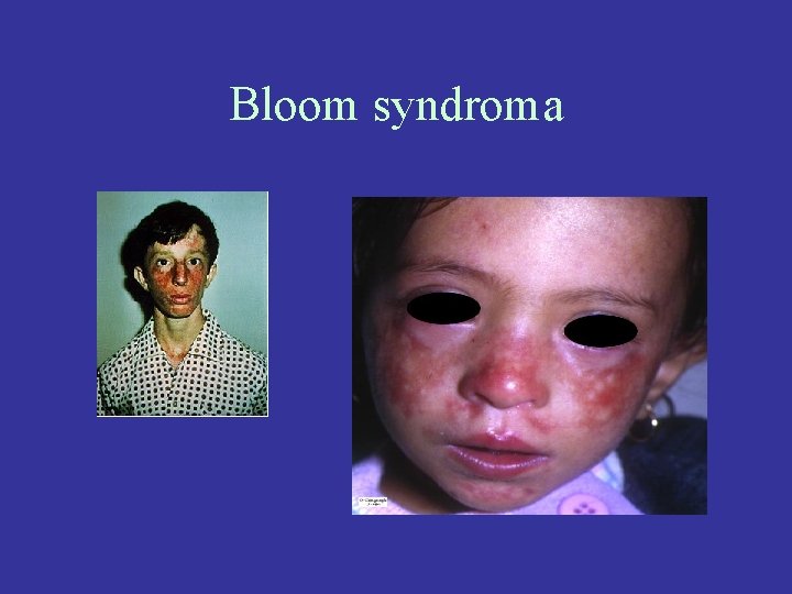 Bloom syndroma 