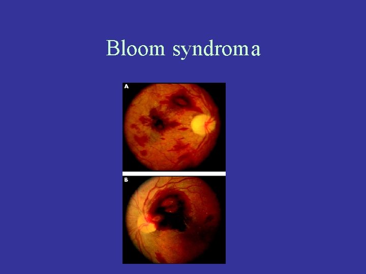 Bloom syndroma 