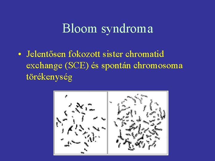 Bloom syndroma • Jelentősen fokozott sister chromatid exchange (SCE) és spontán chromosoma törékenység 