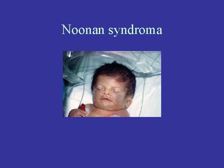 Noonan syndroma 