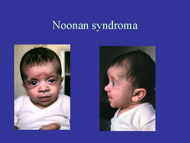 Noonan syndroma 