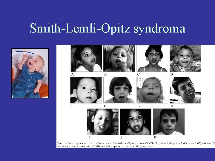 Smith-Lemli-Opitz syndroma 