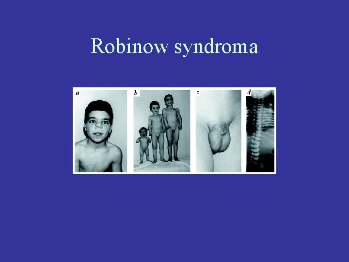 Robinow syndroma 