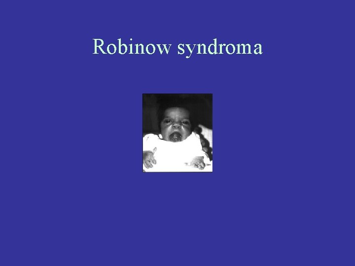 Robinow syndroma 