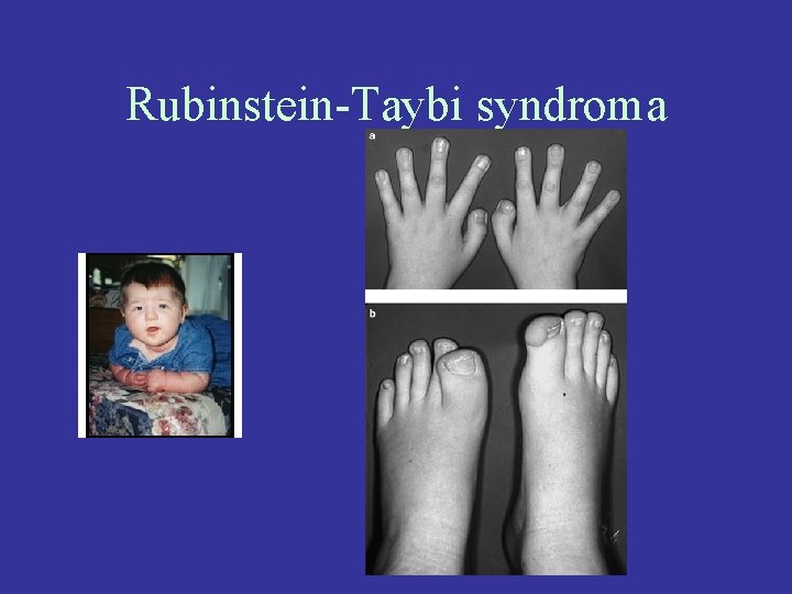 Rubinstein-Taybi syndroma 