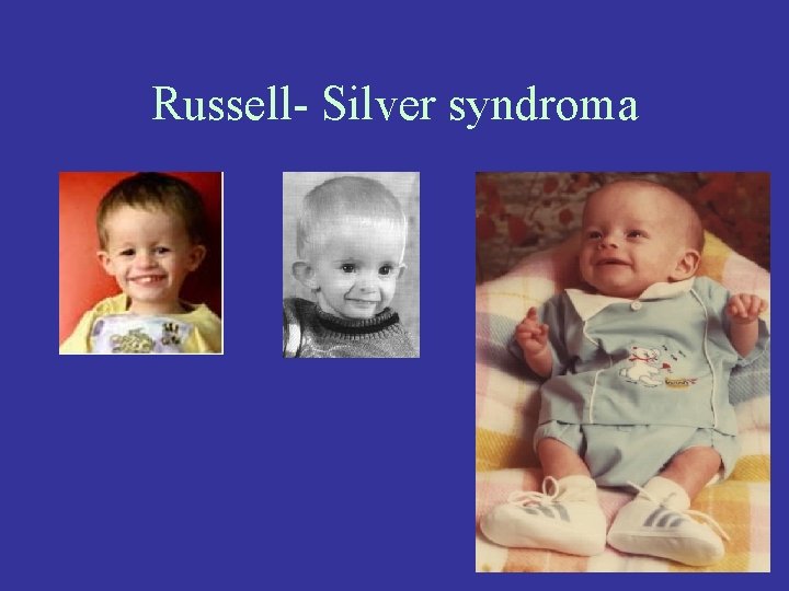 Russell- Silver syndroma 