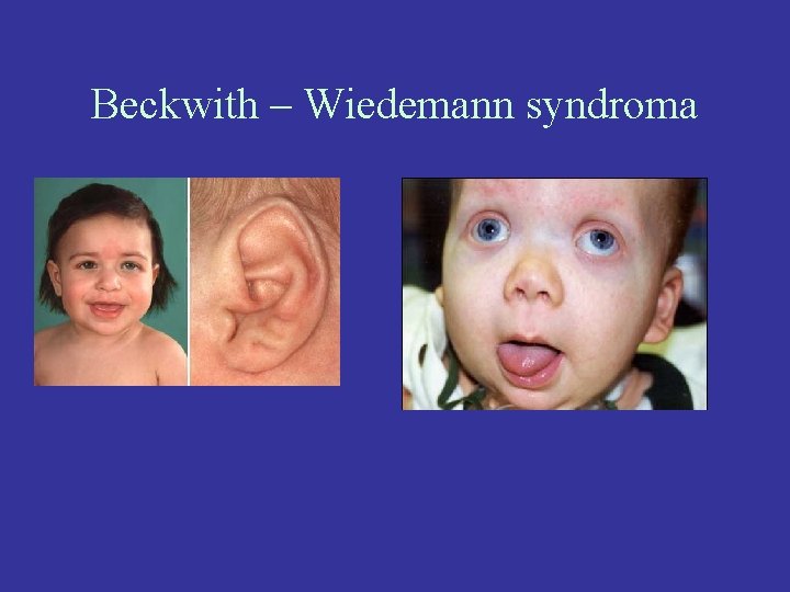 Beckwith – Wiedemann syndroma 