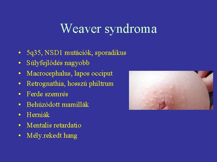 Weaver syndroma • • • 5 q 35, NSD 1 mutációk, sporadikus Súlyfejlődés nagyobb