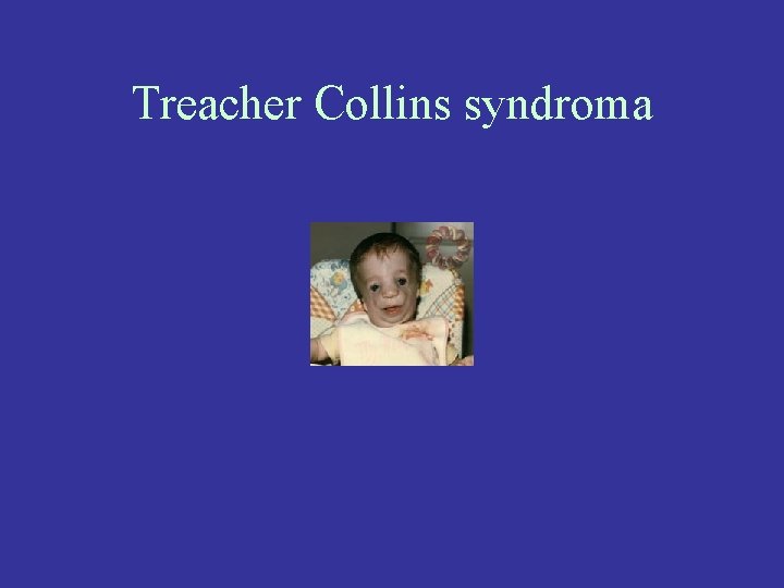 Treacher Collins syndroma 