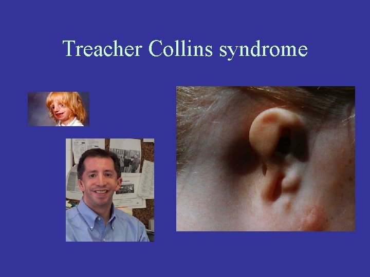 Treacher Collins syndrome 