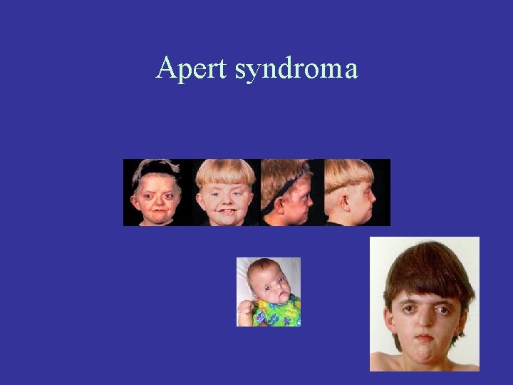 Apert syndroma 