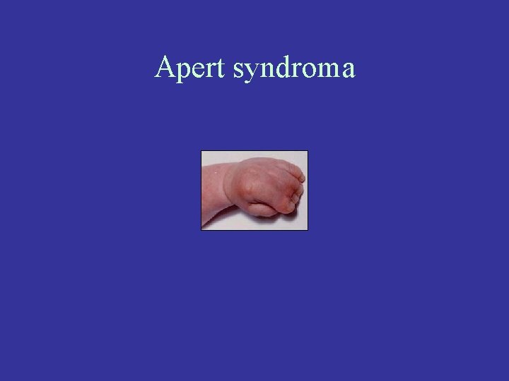 Apert syndroma 