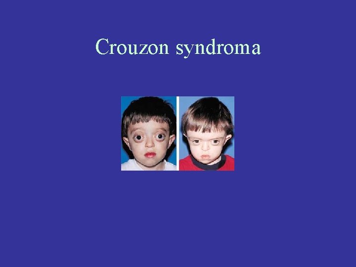 Crouzon syndroma 