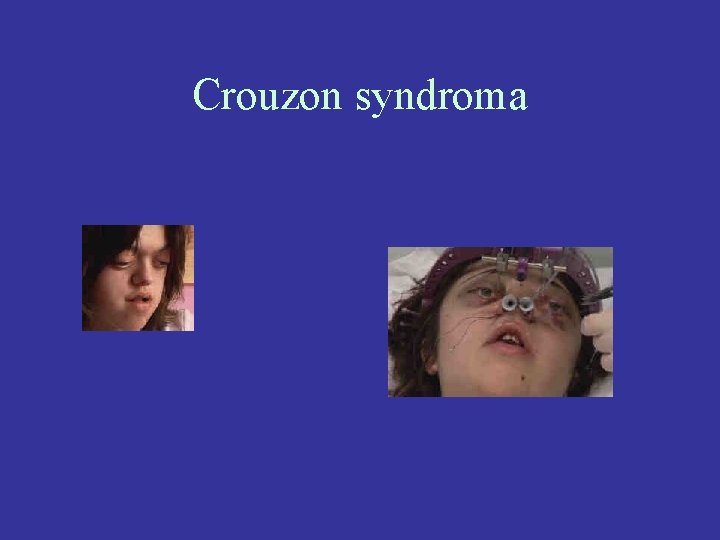 Crouzon syndroma 