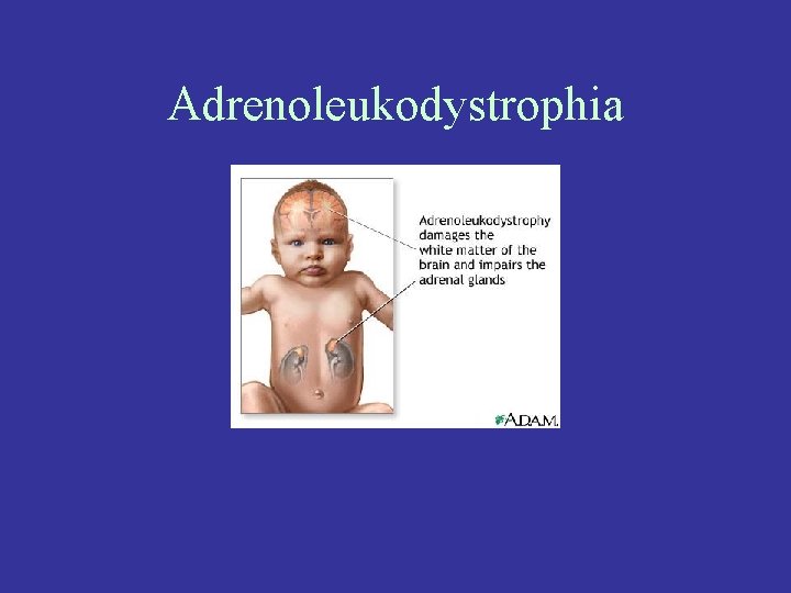 Adrenoleukodystrophia 