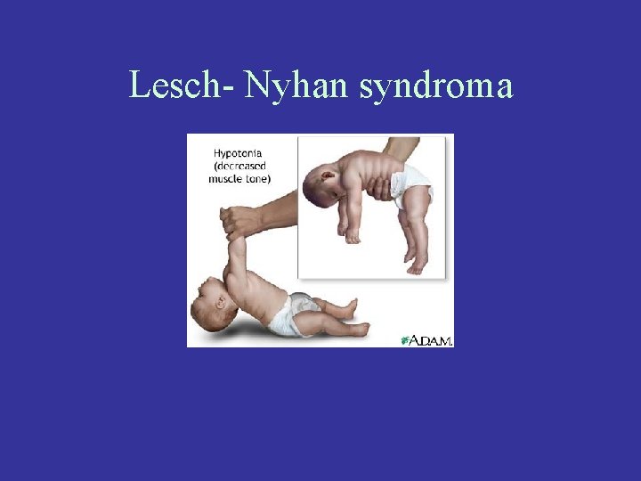 Lesch- Nyhan syndroma 
