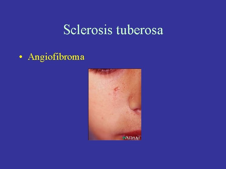 Sclerosis tuberosa • Angiofibroma 