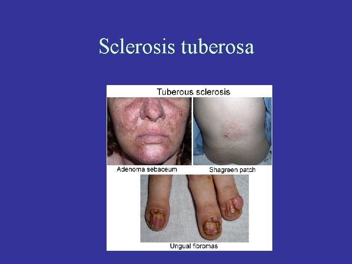 Sclerosis tuberosa 