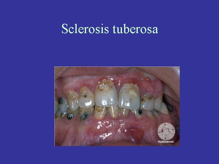 Sclerosis tuberosa 
