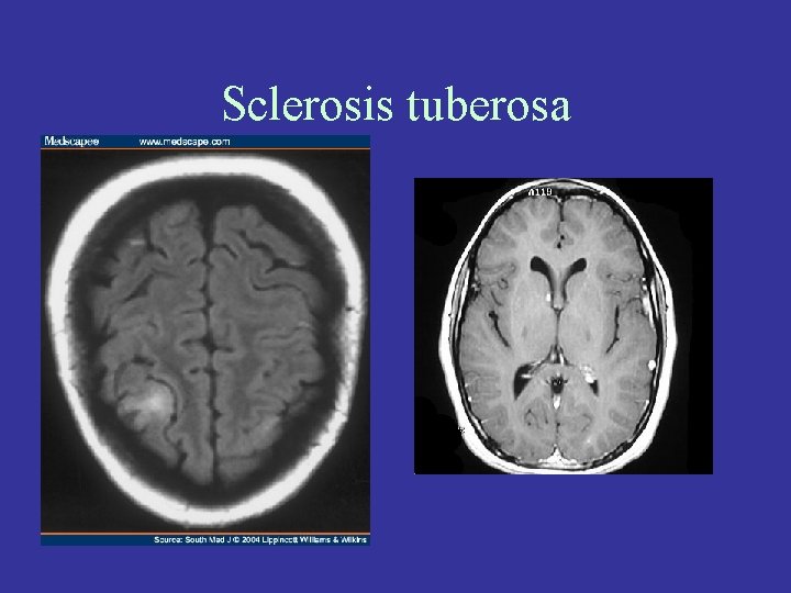 Sclerosis tuberosa 