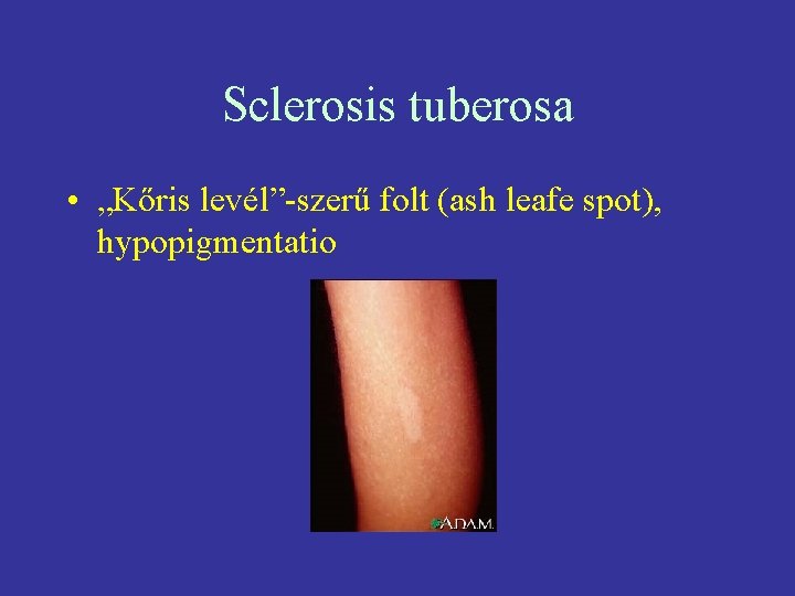 Sclerosis tuberosa • „Kőris levél”-szerű folt (ash leafe spot), hypopigmentatio 