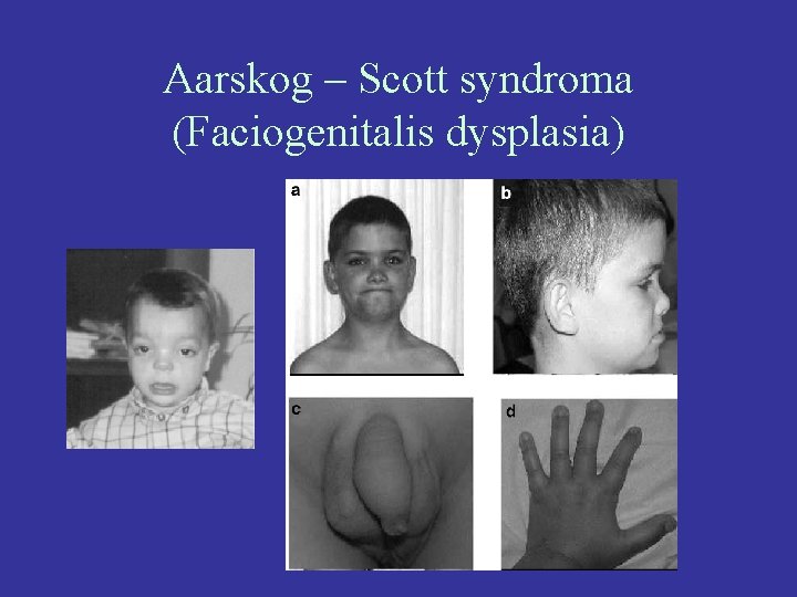 Aarskog – Scott syndroma (Faciogenitalis dysplasia) 