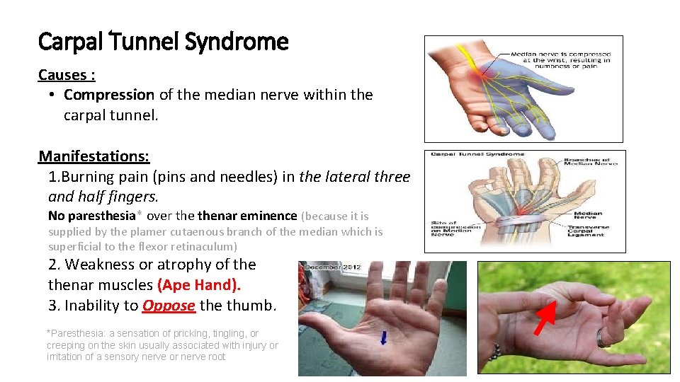 Carpal Tunnel Syndrome Causes : • Compression of the median nerve within the carpal