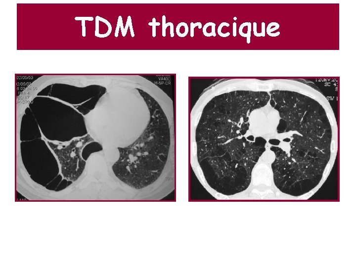 TDM thoracique 