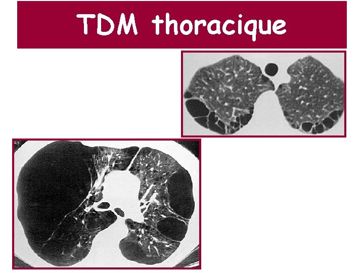 TDM thoracique 