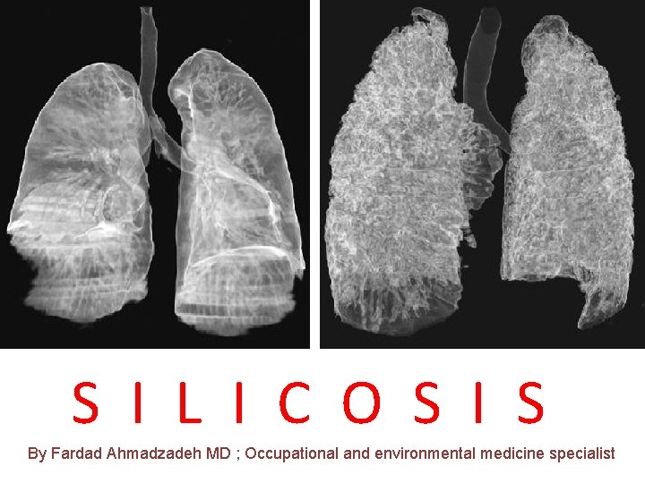 SILICOSIS S I L I C O S I S By Fardad Ahmadzadeh MD