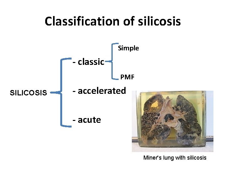 Classification of silicosis Simple - classic PMF SILICOSIS - accelerated - acute Miner's lung